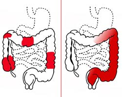Colitis Colitis