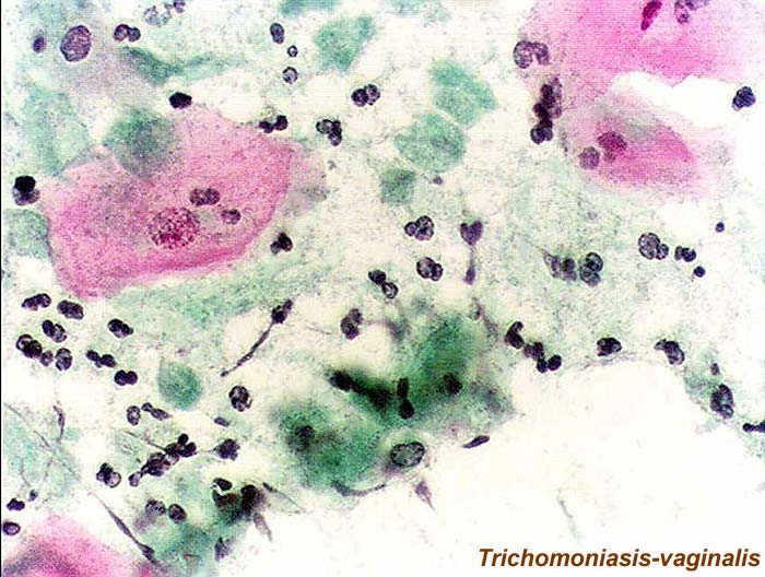 Trichomoniasis vaginalis Trichomoniasis vaginalis