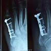 Bone Healing Bone Healing