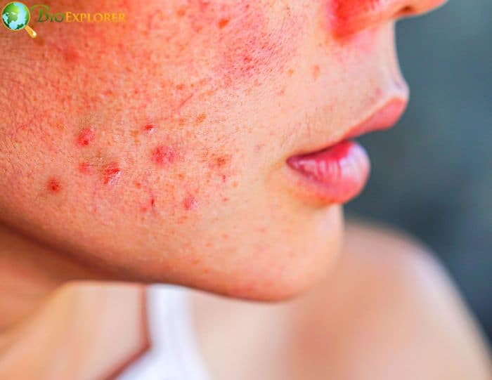 Combat Acnes Combat Acnes