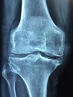 Osteoporosis Osteoporosis