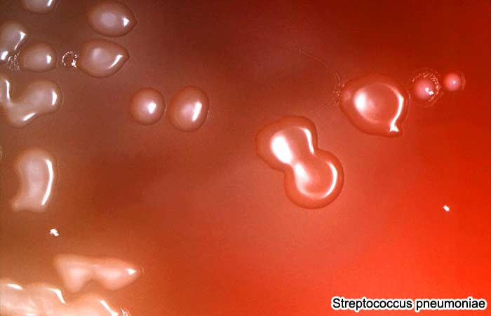 Streptococcus pneumoniae causes Meningitis Streptococcus pneumoniae causes Meningitis