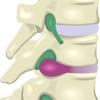 Spinal Disc Spinal Disc
