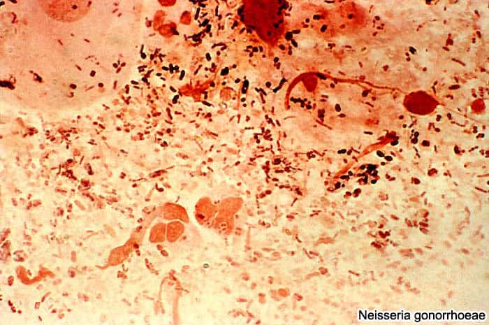 Gonorrhea Gonorrhea