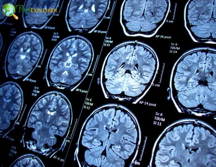 Neurological Diseases Neurological Diseases