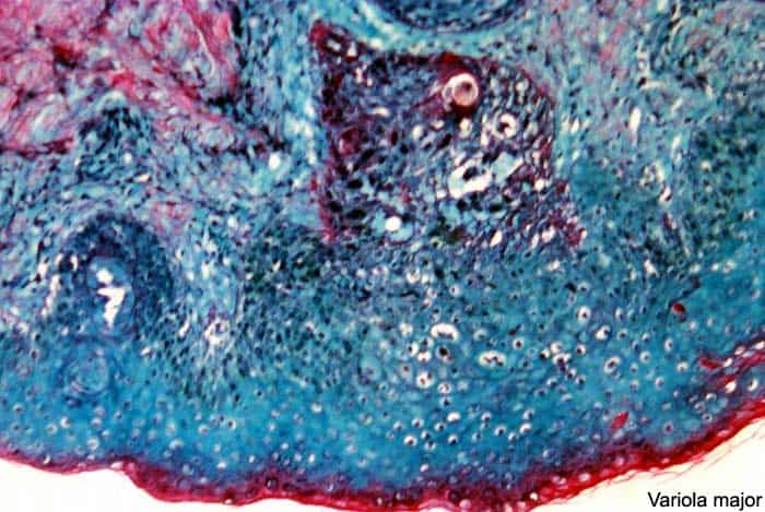 Variola major causes Smallpox Variola major causes Smallpox