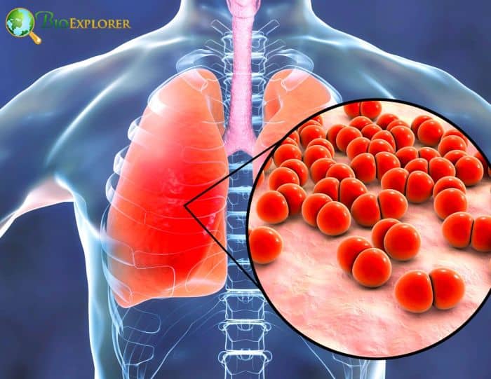 COVID and Pneumonia Differences COVID and Pneumonia Differences