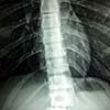 Spinal Cord Spinal Cord