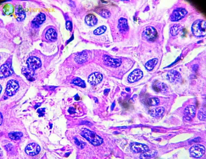 Hepatocellular Carcinoma Hepatocellular Carcinoma