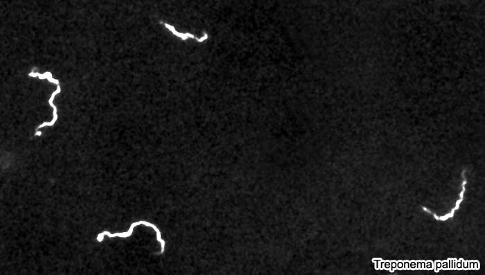 Treponema pallidum causes Syphilis Treponema pallidum causes Syphilis