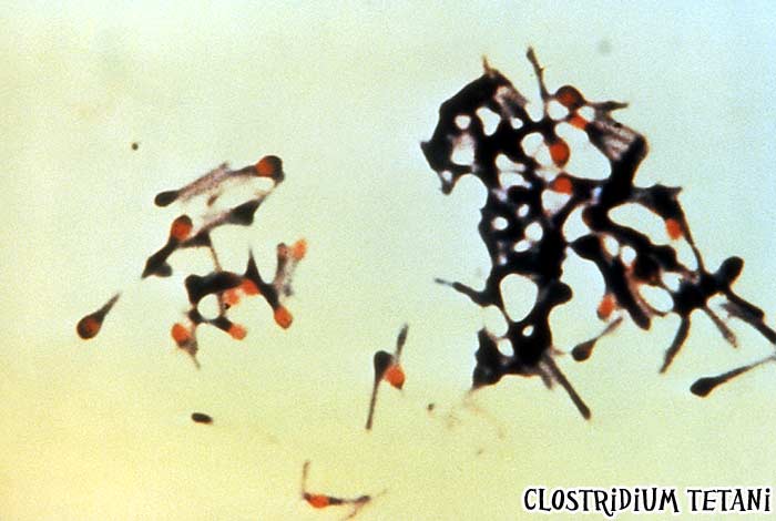 Clostridium tetani causes Tetanus Clostridium tetani causes Tetanus