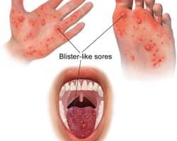 Hand Foot Mouth Disease Hand Foot Mouth Disease