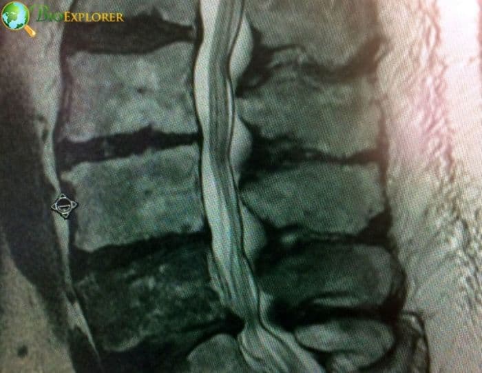 Cancer Metastasis