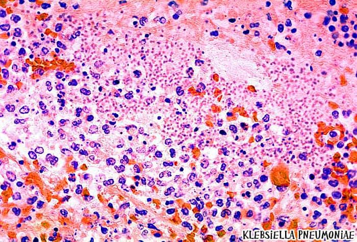 Klebsiella pneumoniae causes Pneumonia Klebsiella pneumoniae causes Pneumonia