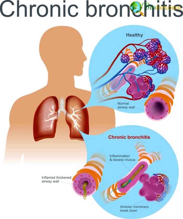Plastic Bronchitis Plastic Bronchitis
