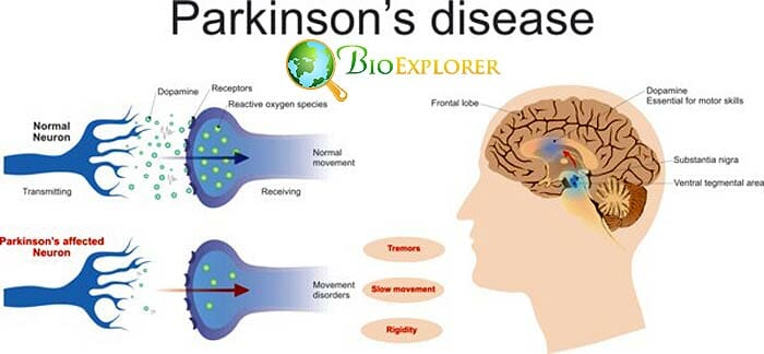 Parkinsons Disease Parkinsons Disease