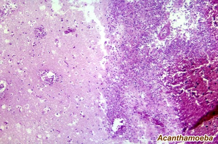Acanthamoeba Acanthamoeba