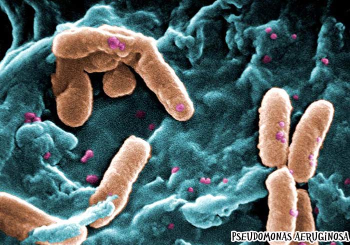 Pseudomona aeruginosa causes Pseudomonas Infection Pseudomona aeruginosa causes Pseudomonas Infection
