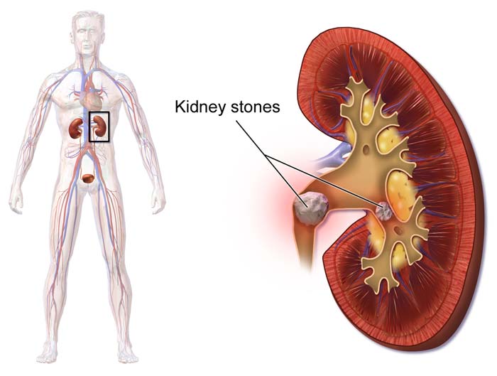 Kidney Stones Kidney Stones