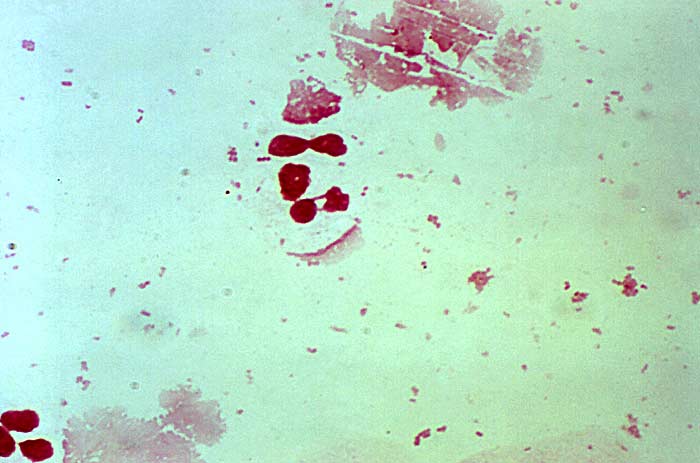 Gonorrhea Neisseria (Pleomorphic) Gonorrhea Neisseria (Pleomorphic)