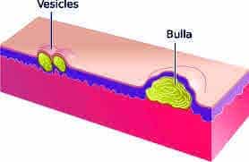 Vesicle Vesicle