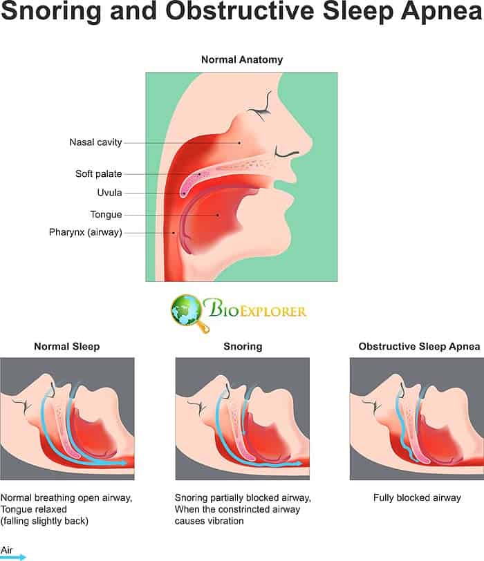 Sleep Disorder Apnea