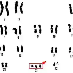 The karyotype of trisomy 21, the cause of Down syndrome.