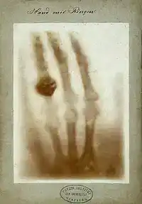 Ghostly black-and-white X-ray of a human hand, bones glowing white against a dark background, with a ring visible around one finger.