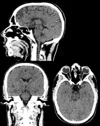 Grayscale cross-sectional scan of a human skull and brain, showing the layered structure of soft tissue from a top-down slice.