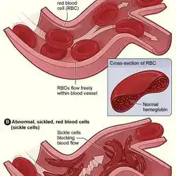 Sickled red blood cells, the target of the first CRISPR medicine.