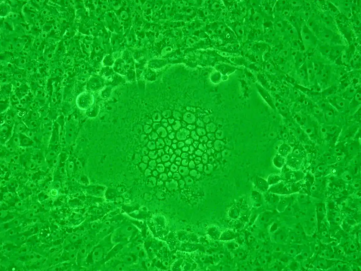 Phase contrast micrograph of a virus-infected cell monolayer showing a large multinucleated syncytium at the centre. Many nuclei are clustered inside a single fused cell mass, surrounded by normal separate cells.