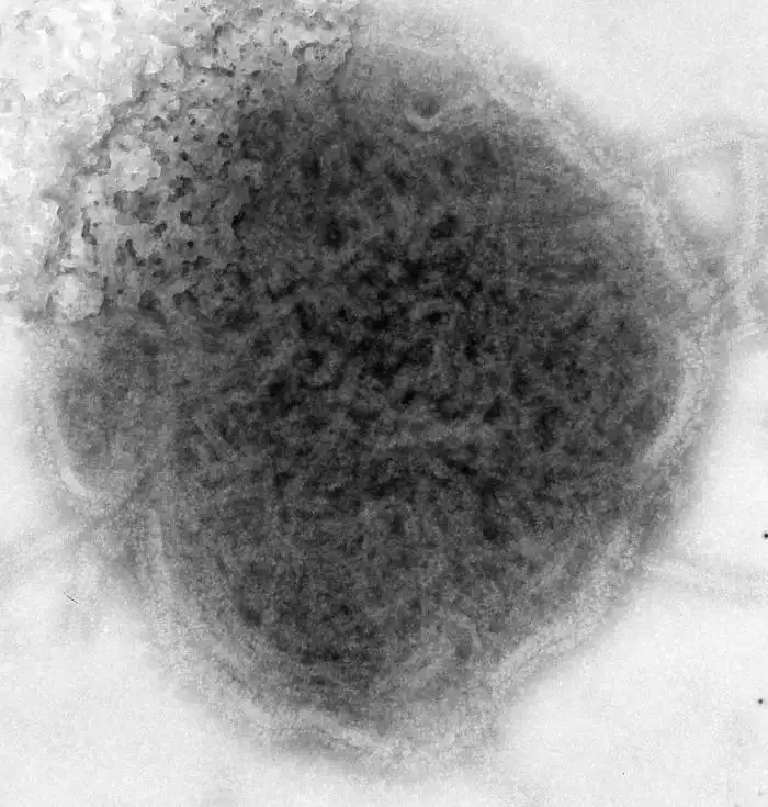 Transmission electron micrograph of a single negatively stained mumps virus particle. The pleomorphic enveloped virion is filled with tangled filamentous nucleocapsid, with stain crystals visible at the upper left.