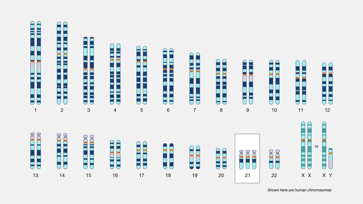 Trisomy 21 karyotype showing three copies of chromosome 21 Human karyotype with three copies of chromosome 21, the trisomy 21 pattern that defines Down syndrome